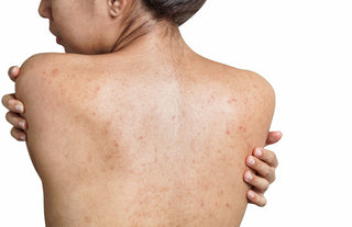 Boutons dans le dos : causes, traitements et soins efficaces