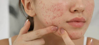 Acné, taches, rougeurs : quelle gamme SVR est faite pour votre peau ?