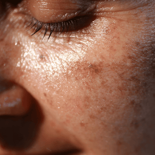 Comment atténuer les taches brunes sur le visage ? Nos conseils et soins efficaces